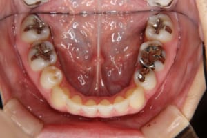 矯正歯科治療後です。左右の第一小臼歯を抜いています。